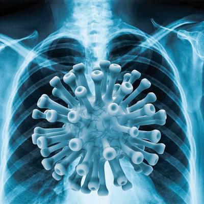 Pneumologie: Mehr als Long-Covid-Versorgung
