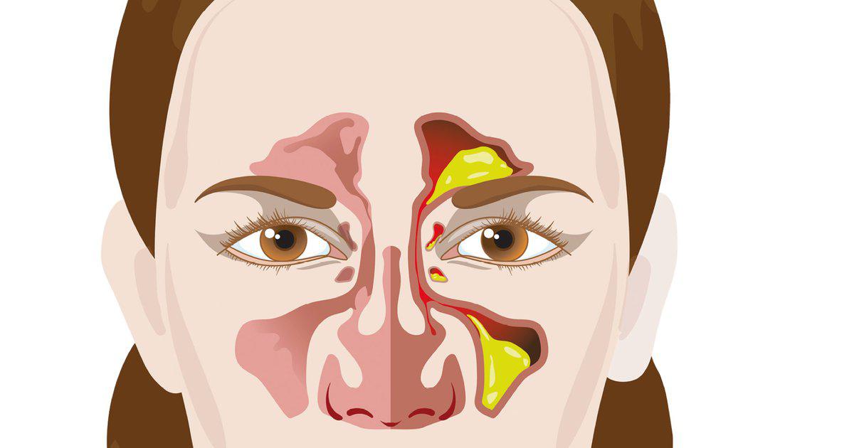 Chronische Rhinosinusitis: Ursachen, Diagnose Und Therapie – EYWUP