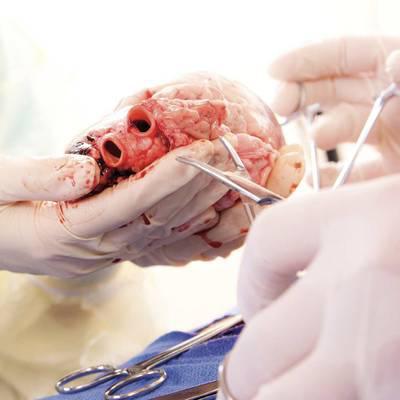 Organspende: Minimierung des Risikos bei Transplantationen
