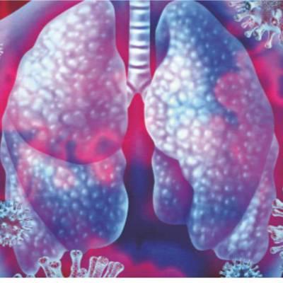 Covid-Update: Spray gegen Lungenschäden